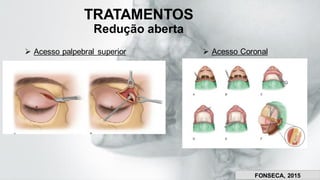 TRATAMENTOS
Redução aberta
➢ Acesso palpebral superior ➢ Acesso Coronal
FONSECA, 2015
 