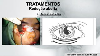 TRATAMENTOS
Redução aberta
➢ Acesso sub ciliar
TIMOTÉO, 2009; PAULESINI, 2008
 