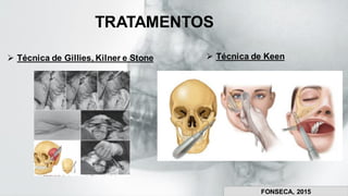 ➢ Técnica de Gillies, Kilner e Stone ➢ Técnica de Keen
TRATAMENTOS
FONSECA, 2015
 