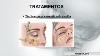 ➢ Técnica com acesso pela sobrancelha
TRATAMENTOS
FONSECA, 2015
FONSECA, 2015
 