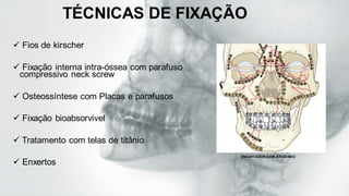 TÉCNICAS DE FIXAÇÃO
✓ Fios de kirscher
✓ Fixação interna intra-óssea com parafuso
compressivo neck screw
✓ Osteossíntese com Placas e parafusos
✓ Fixação bioabsorvivel
✓ Tratamento com telas de titânio
✓ Enxertos
ENCURTADOR.COM.BR/GKMX3
 