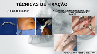 TÉCNICAS DE FIXAÇÃO
➢ Fios de kirscher ➢ Fixação Interna intra-óssea com
parafuso compressivo neck
screw:
PEREIRA, 2019; HEITZ C. et al. , 2005
 