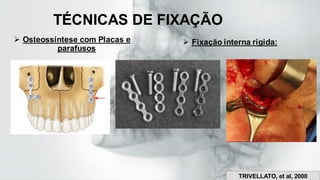 TÉCNICAS DE FIXAÇÃO
➢ Osteossíntese com Placas e
parafusos
➢ Fixação interna rígida:
TRIVELLATO, et aI, 2000
 