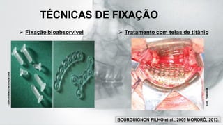 TÉCNICAS DE FIXAÇÃO
➢ Fixação bioabsorvível ➢ Tratamento com telas de titânio
MORORÓ
,
2013
ENCURTADOR.COM.BR/FHEGJ
BOURGUIGNON FILHO et al., 2005 MORORÓ, 2013.
 
