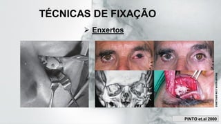 TÉCNICAS DE FIXAÇÃO
➢ Enxertos
ENCURTADOR.COM.BR/GJMS
E
PINTO et.al 2000
 