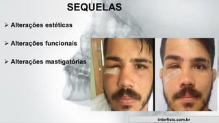 SEQUELAS
➢ Alterações estéticas
➢ Alterações funcionais
➢ Alterações mastigatórias
interfisio.com.br
 