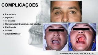 COMPLICAÇÕES
➢ Parestesia
➢ Diplopia
➢ Telecanto
➢ Hemorragia intraorbital e retrobulbar
➢ Enoftalmia
➢Trismo
➢Sinusite Maxilar
Colombo, et al. 2011; JARDIM et al, 2011
 