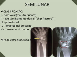 CLASSIFICAÇÃO:
I - polo volar(mais frequente)
II - avulsão ligamento dorsal("chip fracture")
III - polo dorsal
IV - longitudinal do corpo
V - transversa do corpo
Pode estar associado a outras lesões.
 