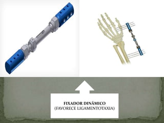 FIXADOR INTERNO DVR
FIXADOR DINÂMICO
(FAVORECE LIGAMENTOTAXIA)
 