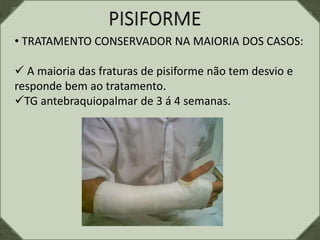 • TRATAMENTO CONSERVADOR NA MAIORIA DOS CASOS:
 A maioria das fraturas de pisiforme não tem desvio e
responde bem ao tratamento.
TG antebraquiopalmar de 3 á 4 semanas.
 