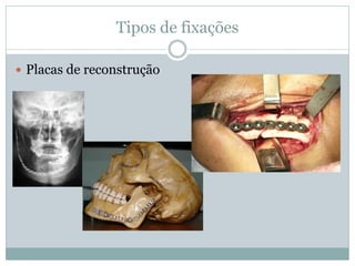 Tipos de fixações

 Placas de reconstrução
 