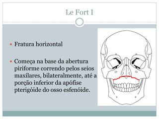 Le Fort I



 Fratura horizontal


 Começa na base da abertura
 piriforme correndo pelos seios
 maxilares, bilateralmente, até a
 porção inferior da apófise
 pterigóide do osso esfenóide.
 
