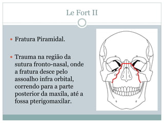 Le Fort II


 Fratura Piramidal.


 Trauma na região da
 sutura fronto-nasal, onde
 a fratura desce pelo
 assoalho infra orbital,
 correndo para a parte
 posterior da maxila, até a
 fossa pterigomaxilar.
 