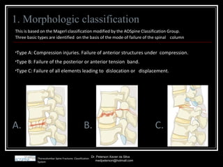 Fratura Toracolombar | PPT