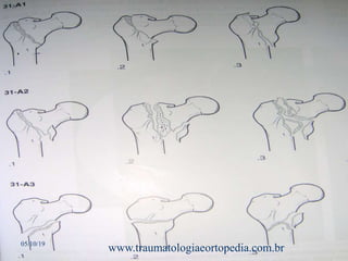 05/10/19
www.traumatologiaeortopedia.com.br
 