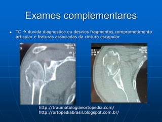 Exames complementares
 TC  duvida diagnostica ou desvios fragmentos,comprometimento
articular e fraturas associadas da cintura escapular
http://traumatologiaeortopedia.com/
http://ortopediabrasil.blogspot.com.br/
 
