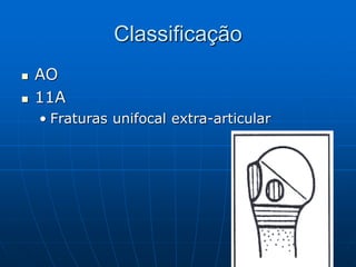 Classificação
 AO
 11A
• Fraturas unifocal extra-articular
 