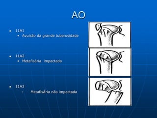 AO
 11A1
• Avulsão da grande tuberosidade
 11A2
• Metafisária impactada
 11A3
- Metafisária não impactada
 
