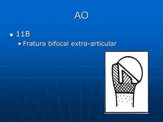 AO
 11B
• Fratura bifocal extra-articular
 