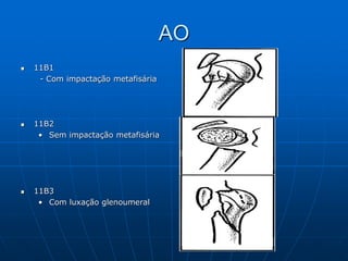 AO
 11B1
- Com impactação metafisária
 11B2
• Sem impactação metafisária
 11B3
• Com luxação glenoumeral
 