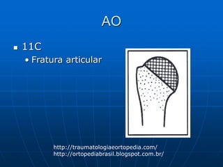 AO
 11C
• Fratura articular
http://traumatologiaeortopedia.com/
http://ortopediabrasil.blogspot.com.br/
 