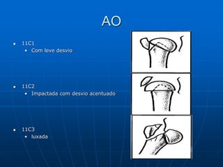 AO
 11C1
• Com leve desvio
 11C2
• Impactada com desvio acentuado
 11C3
• luxada
 