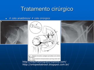 Tratamento cirúrgico
 # colo anatômico/ # colo cirúrgico
http://traumatologiaeortopedia.com/
http://ortopediabrasil.blogspot.com.br/
 