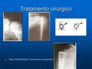 Tratamento cirúrgico
 Placa PFS(Pavilhão Fernandinho Simonsen)
 