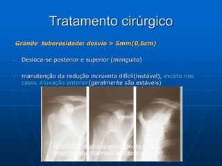 Tratamento cirúrgico
Grande tuberosidade: desvio > 5mm(0,5cm)
- Desloca-se posterior e superior (manguito)
- manutenção da redução incruenta difícil(instável), exceto nos
casos #luxação anterior(geralmente são estáveis)
http://traumatologiaeortopedia.com/
http://ortopediabrasil.blogspot.com.br/
 