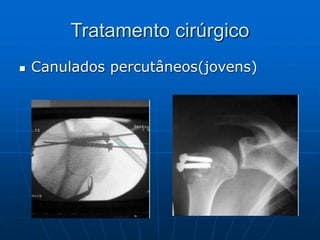 Tratamento cirúrgico
 Canulados percutâneos(jovens)
 