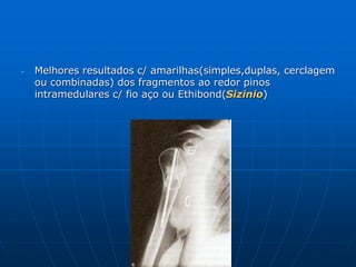 - Melhores resultados c/ amarilhas(simples,duplas, cerclagem
ou combinadas) dos fragmentos ao redor pinos
intramedulares c/ fio aço ou Ethibond(Sizinio)
 