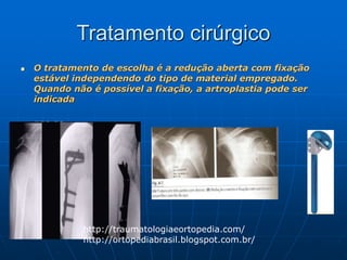 Tratamento cirúrgico
 O tratamento de escolha é a redução aberta com fixação
estável independendo do tipo de material empregado.
Quando não é possível a fixação, a artroplastia pode ser
indicada
 EFC 23
http://traumatologiaeortopedia.com/
http://ortopediabrasil.blogspot.com.br/
 