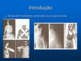 Introdução
 Década 60 tratamento conservador ou cirurgia de Jones
 