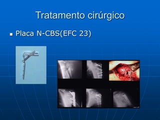Tratamento cirúrgico
 Placa N-CBS(EFC 23)
 