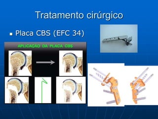 Tratamento cirúrgico
 Placa CBS (EFC 34)
 