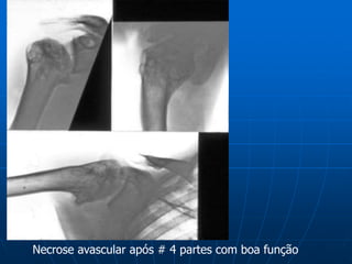 Necrose avascular após # 4 partes com boa função
 