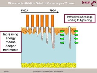 All skin types & body areasFraxel re:pair – Ablative CO21 treatment