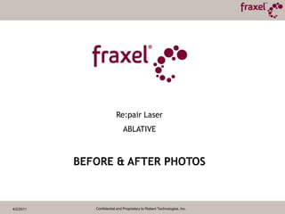 Great for skin laxity4/2/2011Confidential and Proprietary to Reliant Technologies, Inc.Understanding Skin RejuvenationHigh Potential with High RiskSkin RejuvenationTraditionalAblative ResurfacingComplete Vaporization – Result here is pigment loss