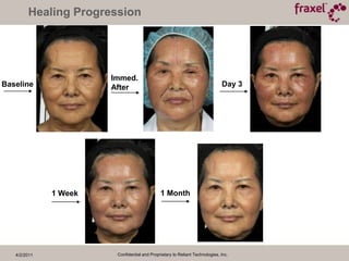 4/2/2011Confidential and Proprietary to Reliant Technologies, Inc.What’s new with Fraxel?Introducing the NEW Fraxel re:pair LaserDeep, fractionalCO2 resurfacing laser Single treatmentMinimal downtime (up to 1 week)Works great to tighten skin at the same time
