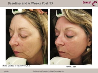 4/2/2011Confidential and Proprietary to Reliant Technologies, Inc.Key benefits of Fraxel re:pair™ laser treatment FDA cleared on or off the faceResurfacingDeep Wrinkles, fine lines, furrows Skin laxity (looseness, sagging))Vascular dyschromia (broken capillaries)	Textural irregularities Pigmentation Acne and Surgical Scars including stretch marks ** Pending FDA clearance
