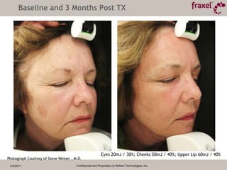 Multiple Skin Aging/Damage Issues4/2/2011Confidential and Proprietary to Reliant Technologies, Inc.WrinklesFoldsVolume LossDiscolorationTextural Problems