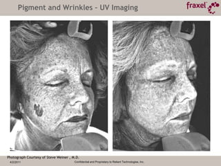 4/2/2011Confidential and Proprietary to Reliant Technologies, Inc.Unparalleled Safety	Over 2500 treatments with more than 3 years of data to back up all claimsZero cases of delayed onset hypopigmentationResults comparable to conventional CO2 treatmentClinical downtime as low as 48 hours (expect a week)Greatly reduced risk forDelayed onset hypopigmentation ScarringPost-inflammatory hyper-pigmentationPersistent erythemaInfection