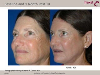 4/2/2011Confidential and Proprietary to Reliant Technologies, Inc.Why Fraxel re:pair treatment is revolutionaryTraditional CO2Fraxel re:pair CO2Fraxel re:store Non-ablative 	Conventional CO2 devices treat contiguous zones of tissue for superficial ablation.  	results in fractional delivery of focused CO2  energy with the ability to safely remove microscopic zones of epidermal and deep dermal tissue.	Fractional results in coagulation of epidermal and dermal tissue, with sparing between each microscopic treatment zones.