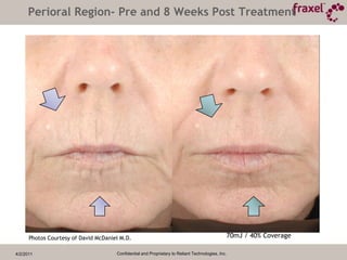 4/2/2011Confidential and Proprietary to Reliant Technologies, Inc.FMDA                                FDDAMicroscopic Ablation Detail of Fraxelre:pairTM LaserImmediate Shrinkage leading to tighteningIncreasing energy means deeper treatments