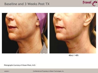 4/2/2011Confidential and Proprietary to Reliant Technologies, Inc.Why Fraxel re:pairTM Laser treatment?