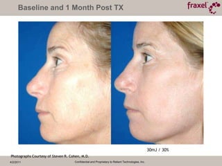 4/2/2011Confidential and Proprietary to Reliant Technologies, Inc.Re:pair LaserABLATIVEBEFORE & AFTER PHOTOS