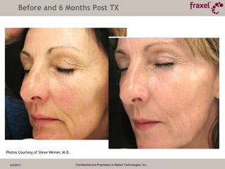 4/2/2011Confidential and Proprietary to Reliant Technologies, Inc.Immed.AfterDay 3Baseline1 Month1 WeekHealing Progression