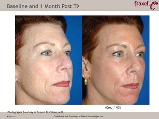 4/2/2011Confidential and Proprietary to Reliant Technologies, Inc.Baseline and 6 Weeks Post TXPhotos Courtesy of Steve Weiner, M.D.40mJ / 35%