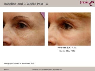 4/2/2011Confidential and Proprietary to Reliant Technologies, Inc.Baseline and 3 Months Post TX Eyes 20mJ / 30%; Cheeks 50mJ / 40%; Upper Lip 60mJ / 40% Photograph Courtesy of Steve Weiner , M.D.
