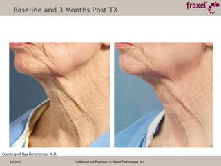 4/2/2011Confidential and Proprietary to Reliant Technologies, Inc.Baseline and 1 Month Post TX40mJ / 40%Photographs Courtesy of Steven R. Cohen, M.D.